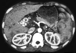 Cavernous Transformation of the Portal Vein With Clot in Portal Vein (PV) - CTisus CT Scan