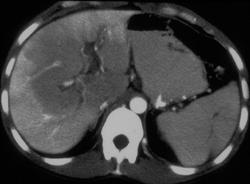 Portal Vein Thrombosis With Flow Changes in Liver - CTisus CT Scan