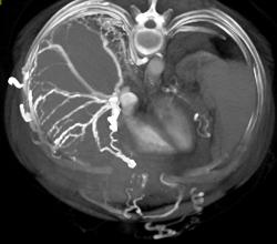 Collaterals Along the Surface of the Liver Due to SVC - CTisus CT Scan