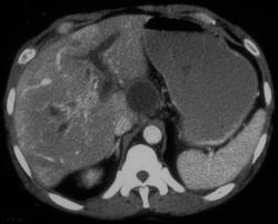 Portal Vein Thrombosis - CTisus CT Scan