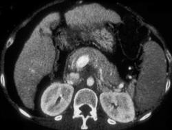 Flow Related Changes on Portal Vein Or Early Phase Images (pseudo-clot) - CTisus CT Scan