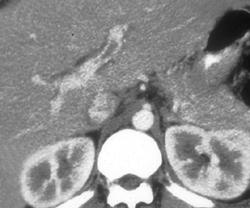 Partial Clot in Left Portal Vein - CTisus CT Scan