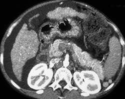 Pseudo clot in Portal Vein/Superior Mesenteric Vein (SMV) - CTisus CT Scan