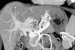 Portal Vein Thrombosis and Varices - CTisus CT Scan