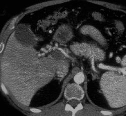 Portal Vein Thrombosis - CTisus CT Scan