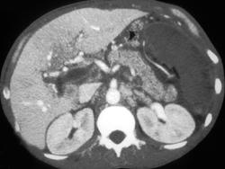 Portal Vein Thrombosis - CTisus CT Scan