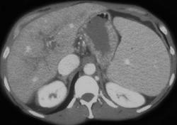 Portal Vein Thrombosis - CTisus CT Scan