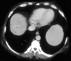 Hepatoma - CTisus CT Scan