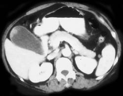 Incidental Gallbladder Polyp Which Was Malignant - CTisus CT Scan