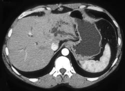 Cholangiocarcinoma - CTisus CT Scan