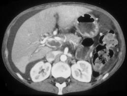 Superior Mesenteric Vein (SMV) - CTisus CT Scan