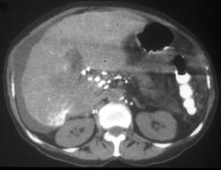 Thoratrast Exposure (see Nodes in Porta) - CTisus CT Scan