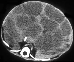 Infantile Hemangioendothelioma - CTisus CT Scan