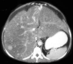 Cirrhosis With Regenerating Nodules (hard to Differentiate From Hepatoma) - CTisus CT Scan