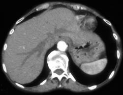 Prominent Hepatic Veins on Early Phase Arterial Study - CTisus CT Scan