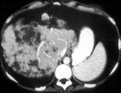 Pseudocirrhosis in Breast Cancer - CTisus CT Scan