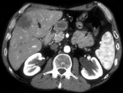 Liver Metastases: Colon Cancer - CTisus CT Scan