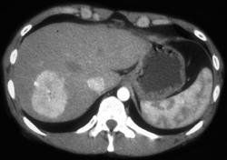 Focal Nodular Hyperplasia (FNH) - CTisus CT Scan