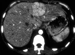 Focal Nodular Hyperplasia (FNH) - CTisus CT Scan