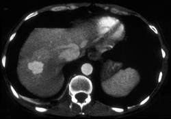 Focal Nodular Hyperplasia (FNH) - CTisus CT Scan