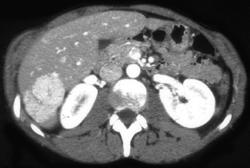 Focal Nodular Hyperplasia (FNH) - CTisus CT Scan