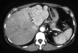 Hepatic Adenoma - CTisus CT Scan