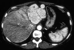 Hepatic Adenoma - CTisus CT Scan