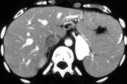 Focal Nodular Hyperplasia (FNH) (see Prior Image) - CTisus CT Scan