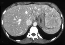 Fnh (focal Nodular Hyperplasia) - CTisus CT Scan