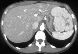 Focal Nodular Hyperplasia (FNH) - CTisus CT Scan