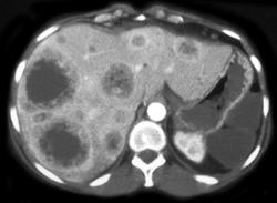 Liver Metastases - CTisus CT Scan