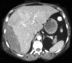 Multiple Hepatic Adenomas W/ One That Bleeds & Subcapsular Hematoma ...