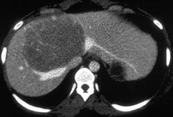 Atypical Hepatic Adenoma - CTisus CT Scan