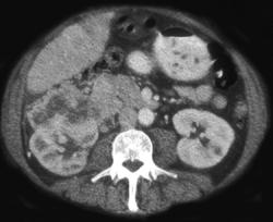 Vascular Metastases From Renal Cell Carcinoma - CTisus CT Scan