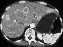 Liver Metastases on Dual Phase Imaging - CTisus CT Scan