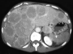 Islet Cell Metastases on Dual Phase - CTisus CT Scan