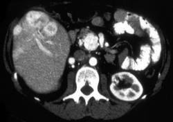 Islet Cell in Pancreatic Head With Liver Metastases - CTisus CT Scan