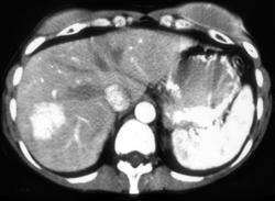 Focal Nodular Hyperplasia (FNH) in Breast Cancer - CTisus CT Scan