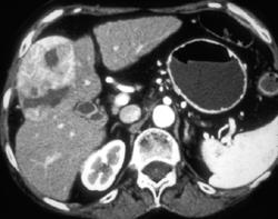 Hepatoma - CTisus CT Scan