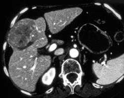 Hepatoma - CTisus CT Scan