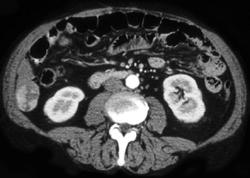 Hepatoma - CTisus CT Scan