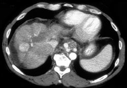 Hepatoma - CTisus CT Scan