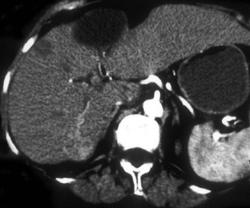 Metastases - CTisus CT Scan