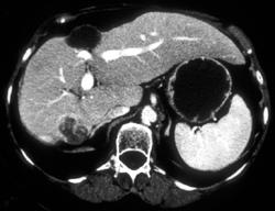 Metastases Liver - CTisus CT Scan