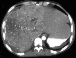 Hepatoma - CTisus CT Scan