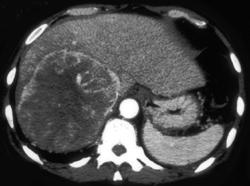 Hepatoma - CTisus CT Scan