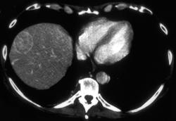 Hepatoma - CTisus CT Scan