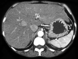 Metastases to Liver - CTisus CT Scan