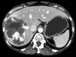 Hemangioma - CTisus CT Scan