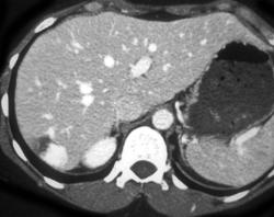 Hemangioma - CTisus CT Scan